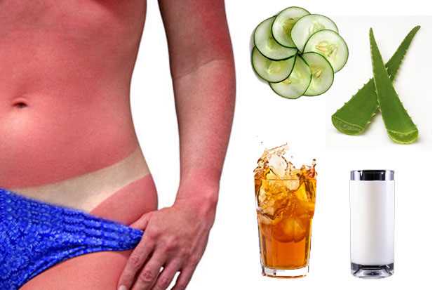 Remedios naturales para tratar las quemaduras de sol 
