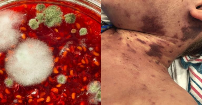 » Por comer sobras, estudiante termina con falla orgánica y extremidades amputadas