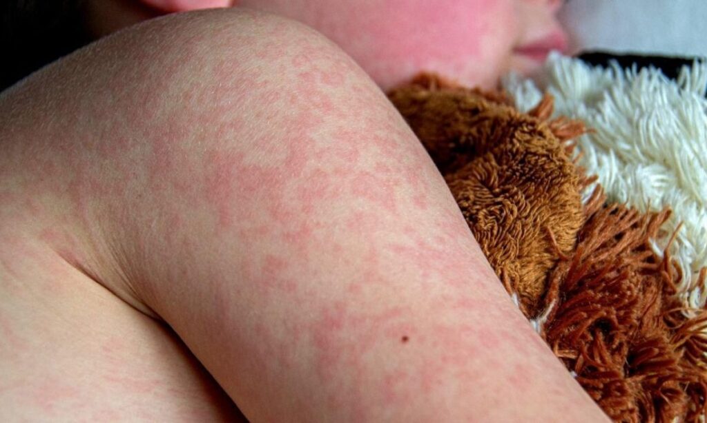 OPS emite alerta epidemiológica por sarampión