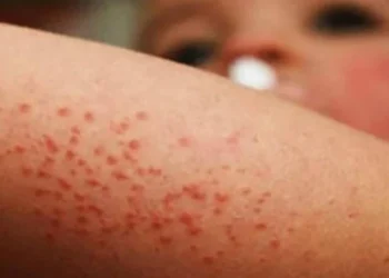 Los casos de sarampión llegan a 19 en El Salvador, con 5 contagios más registrados en mayo