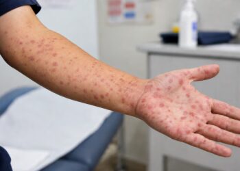 Chile alcanza récord de contagios de sífilis y las mujeres mayores de 60 años son las más afectadas