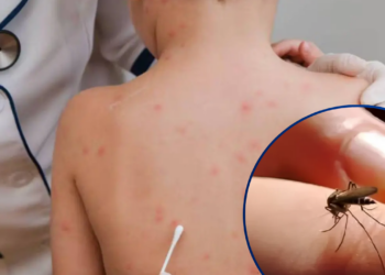 ¡Alerta en Honduras! Dengue, sarampión y tosferina siguen bajo vigilancia sanitaria