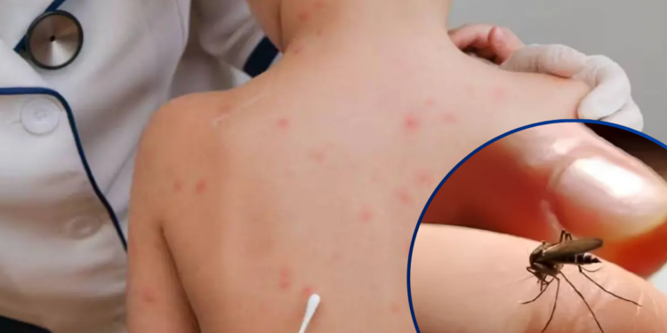 ¡Alerta en Honduras! Dengue, sarampión y tosferina siguen bajo vigilancia sanitaria