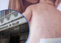 ¡Otro menor! Sesal confirma un nuevo caso de sarampión, se trata de un bebé de 6 meses