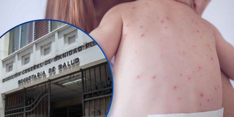 ¡Otro menor! Sesal confirma un nuevo caso de sarampión, se trata de un bebé de 6 meses